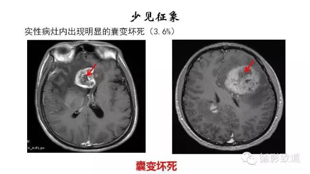 【病例】中枢神经系统淋巴瘤1例MR影像表现