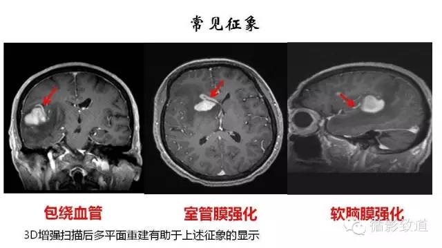 【病例】中枢神经系统淋巴瘤1例MR影像表现
