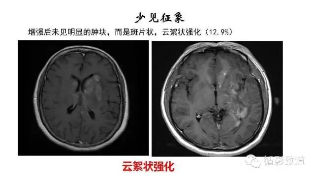 【病例】中枢神经系统淋巴瘤1例MR影像表现