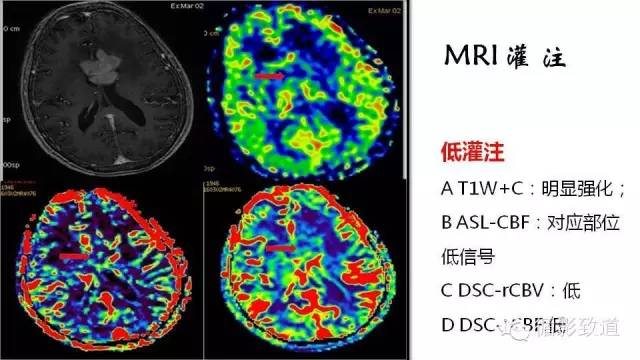 【病例】中枢神经系统淋巴瘤1例MR影像表现