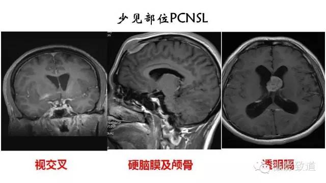 【病例】中枢神经系统淋巴瘤1例MR影像表现
