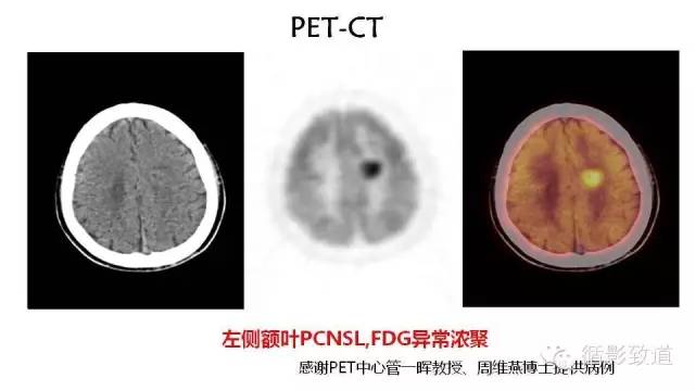 【病例】中枢神经系统淋巴瘤1例MR影像表现