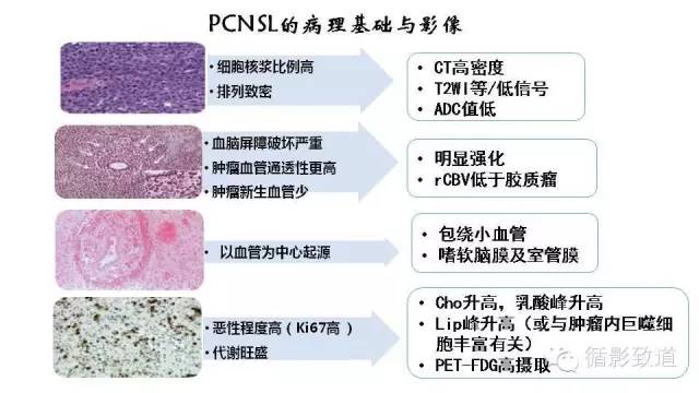 【病例】中枢神经系统淋巴瘤1例MR影像表现
