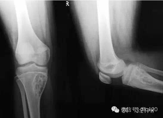 非骨化性纤维瘤 非骨化性纤维瘤