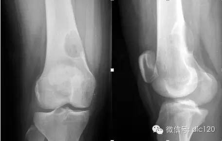 非骨化性纤维瘤 非骨化性纤维瘤