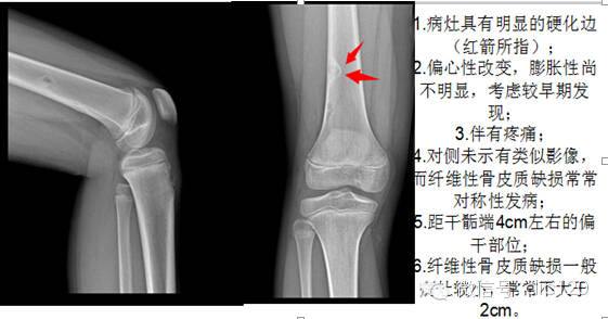 非骨化性纤维瘤 非骨化性纤维瘤