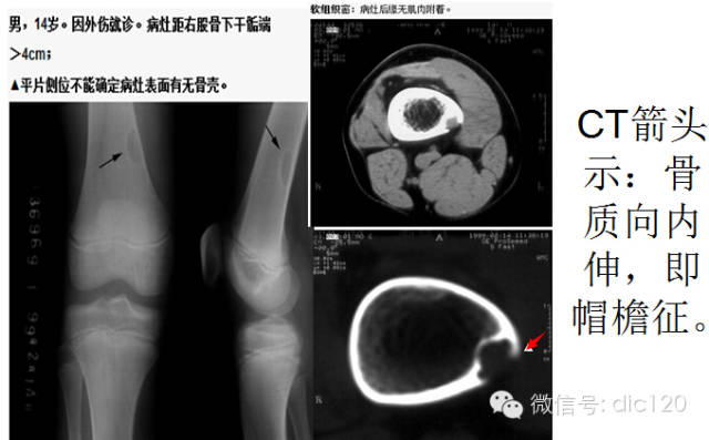 非骨化性纤维瘤 非骨化性纤维瘤