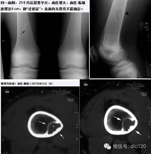非骨化性纤维瘤 非骨化性纤维瘤