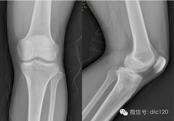 非骨化性纤维瘤 非骨化性纤维瘤