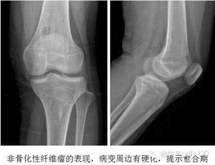 非骨化性纤维瘤 非骨化性纤维瘤
