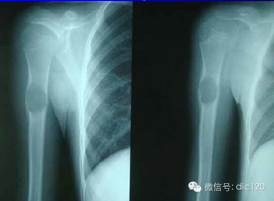 非骨化性纤维瘤 非骨化性纤维瘤