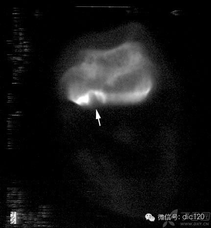 非骨化性纤维瘤 非骨化性纤维瘤