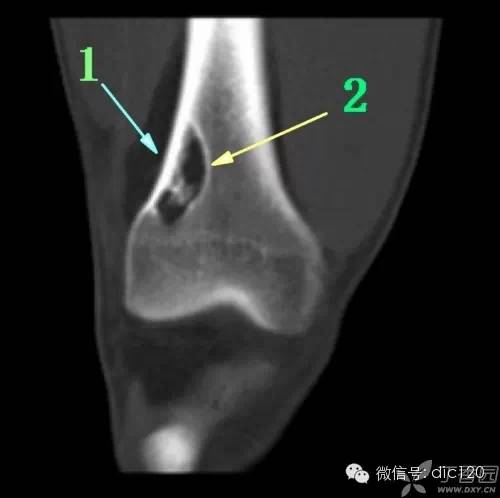 非骨化性纤维瘤 非骨化性纤维瘤