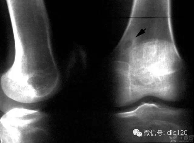 非骨化性纤维瘤 非骨化性纤维瘤