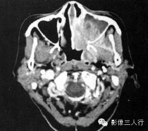 上颌窦癌的CT报告书写技巧与提示 上颌窦癌的CT报告书写技巧与提示