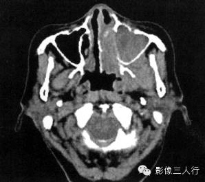 上颌窦癌的CT报告书写技巧与提示