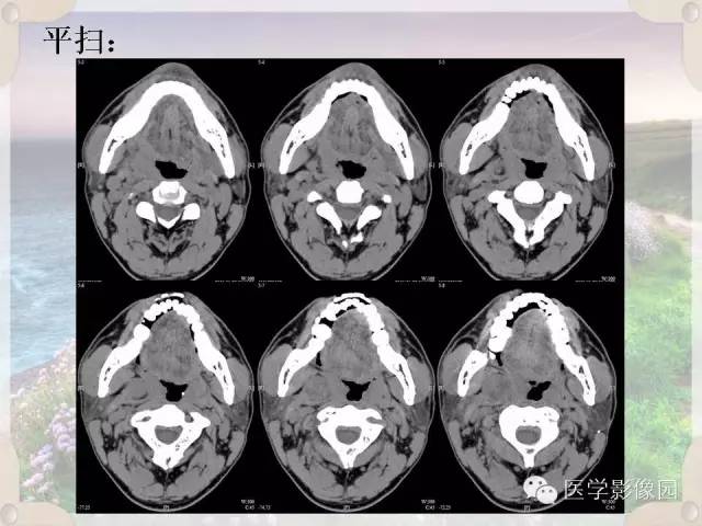 【病例】腮腺深叶基底细胞腺瘤1例CT影像表现