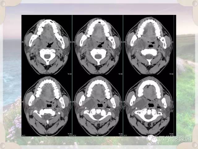 【病例】腮腺深叶基底细胞腺瘤1例CT影像表现