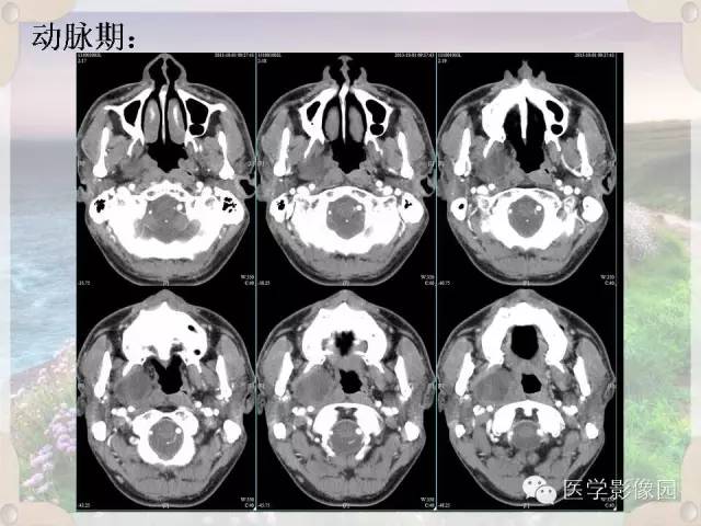 【病例】腮腺深叶基底细胞腺瘤1例CT影像表现