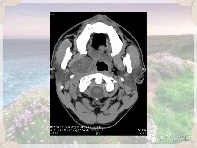 【病例】腮腺深叶基底细胞腺瘤1例CT影像表现