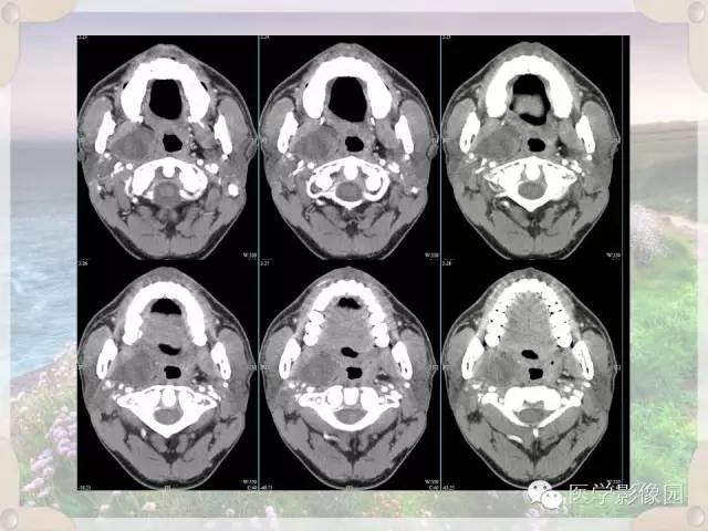 【病例】腮腺深叶基底细胞腺瘤1例CT影像表现