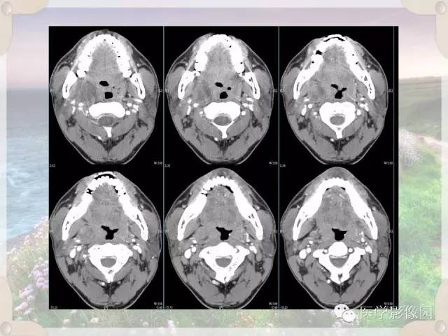 【病例】腮腺深叶基底细胞腺瘤1例CT影像表现