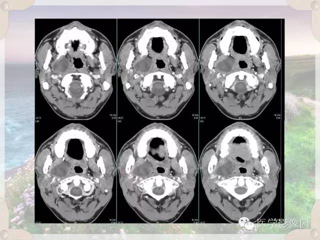 【病例】腮腺深叶基底细胞腺瘤1例CT影像表现