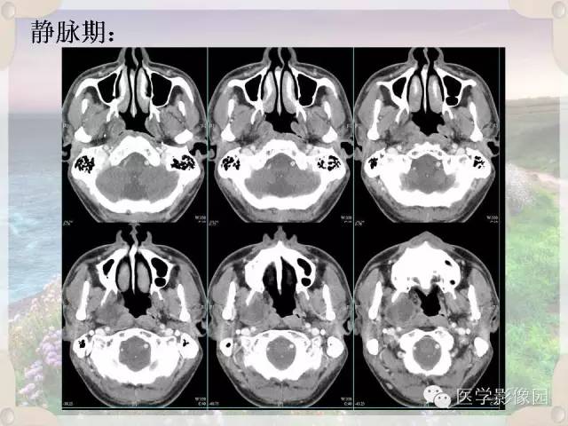 【病例】腮腺深叶基底细胞腺瘤1例CT影像表现