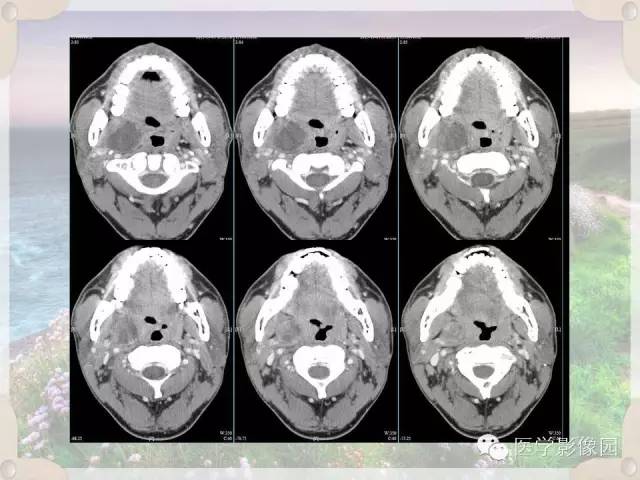 【病例】腮腺深叶基底细胞腺瘤1例CT影像表现