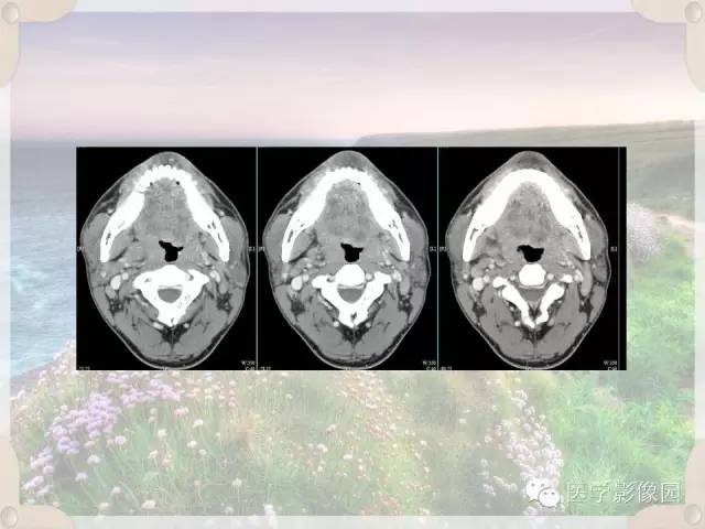 【病例】腮腺深叶基底细胞腺瘤1例CT影像表现