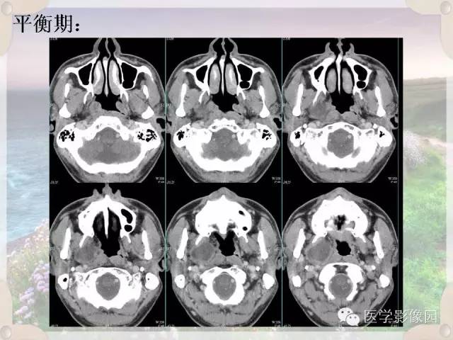 【病例】腮腺深叶基底细胞腺瘤1例CT影像表现