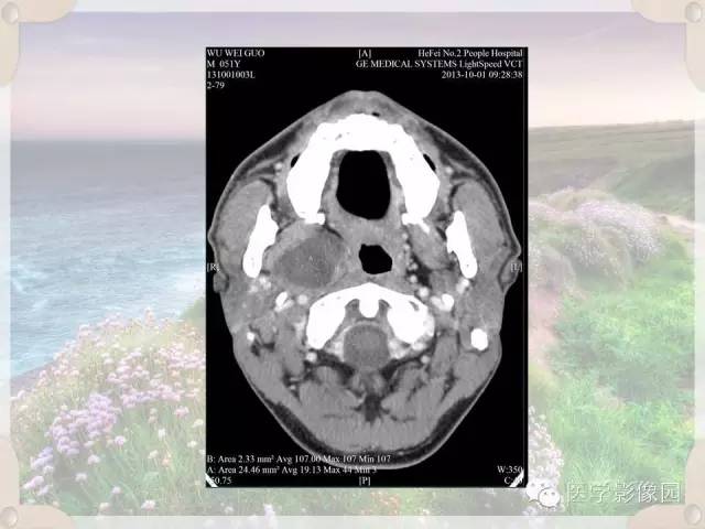 【病例】腮腺深叶基底细胞腺瘤1例CT影像表现
