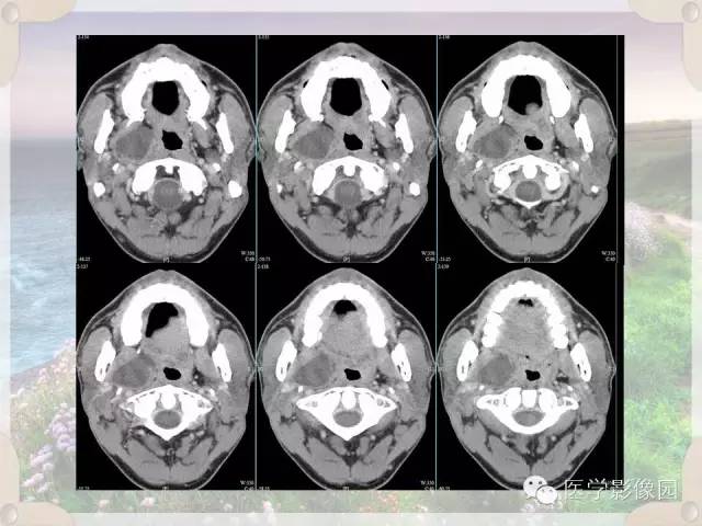 【病例】腮腺深叶基底细胞腺瘤1例CT影像表现