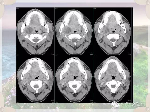 【病例】腮腺深叶基底细胞腺瘤1例CT影像表现