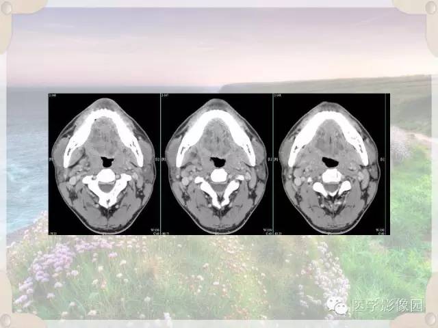 【病例】腮腺深叶基底细胞腺瘤1例CT影像表现