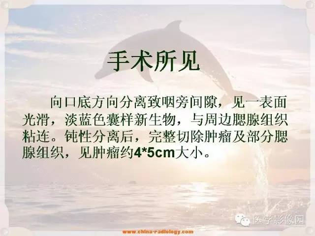 【病例】腮腺深叶基底细胞腺瘤1例CT影像表现