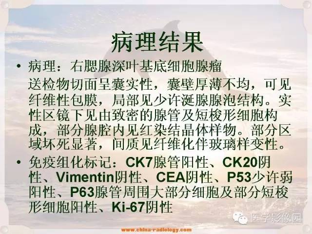 【病例】腮腺深叶基底细胞腺瘤1例CT影像表现