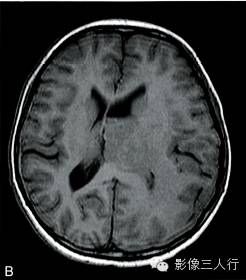 【病例】大脑胶质瘤病1例MR影像表现