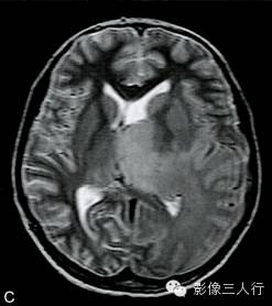 【病例】大脑胶质瘤病1例MR影像表现