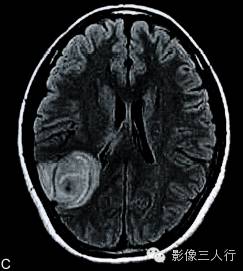 【病例】多形性黄色瘤性星形细胞瘤1例MR影像表现