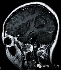 【病例】多形性黄色瘤性星形细胞瘤1例MR影像表现