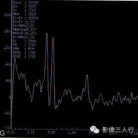 【病例】多形性黄色瘤性星形细胞瘤1例MR影像表现