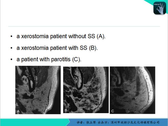 【PPT】腮腺MRI检查对干燥综合征SS的诊断价值