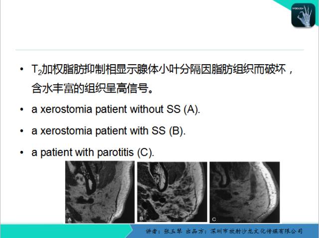 【PPT】腮腺MRI检查对干燥综合征SS的诊断价值