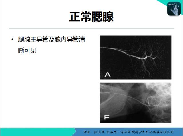 【PPT】腮腺MRI检查对干燥综合征SS的诊断价值