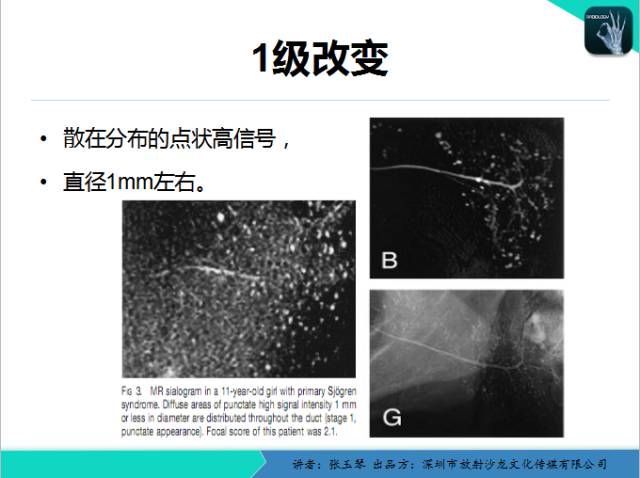 【PPT】腮腺MRI检查对干燥综合征SS的诊断价值