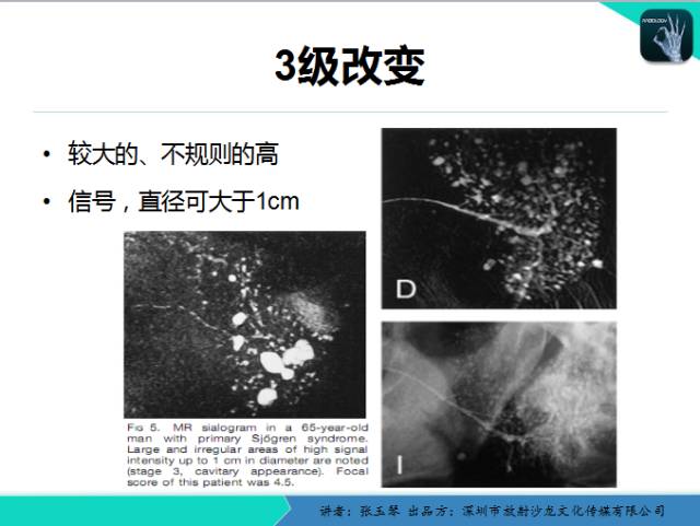 【PPT】腮腺MRI检查对干燥综合征SS的诊断价值