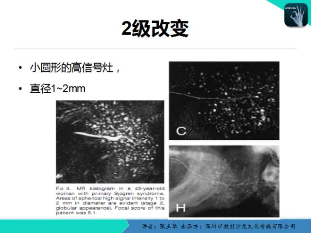 【PPT】腮腺MRI检查对干燥综合征SS的诊断价值