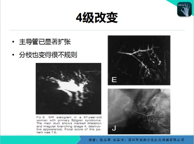 【PPT】腮腺MRI检查对干燥综合征SS的诊断价值