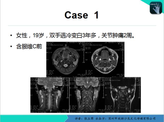 【PPT】腮腺MRI检查对干燥综合征SS的诊断价值